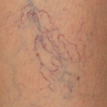 Варикоз — причины, симптомы и лечение варикозного расширения вен на ногах